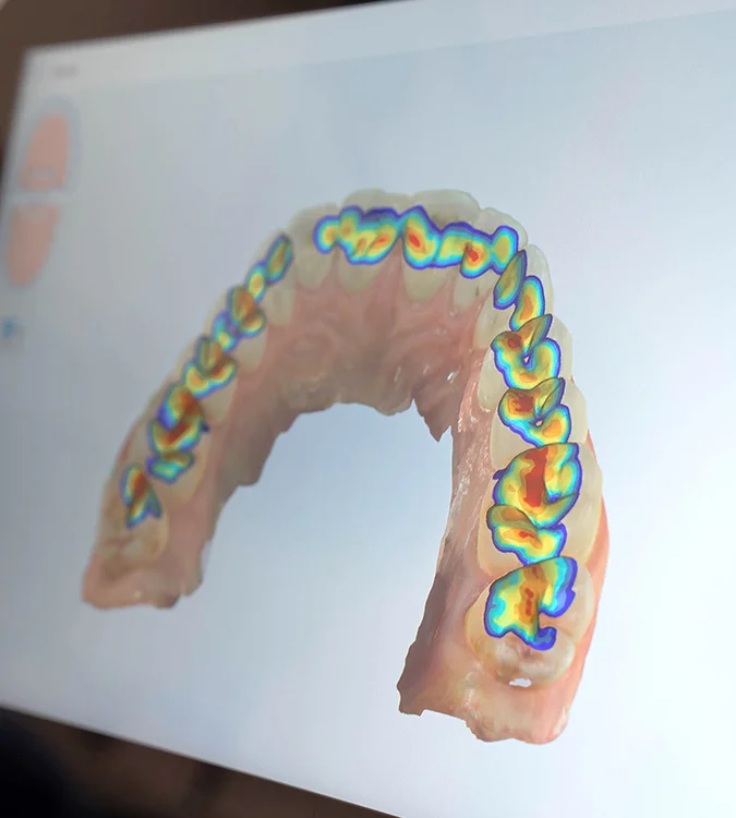 Colour-mapped 3D digital scan of a patient’s lower teeth