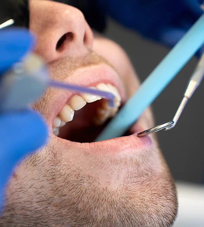 Close-up of a dental clean with suction and mirror