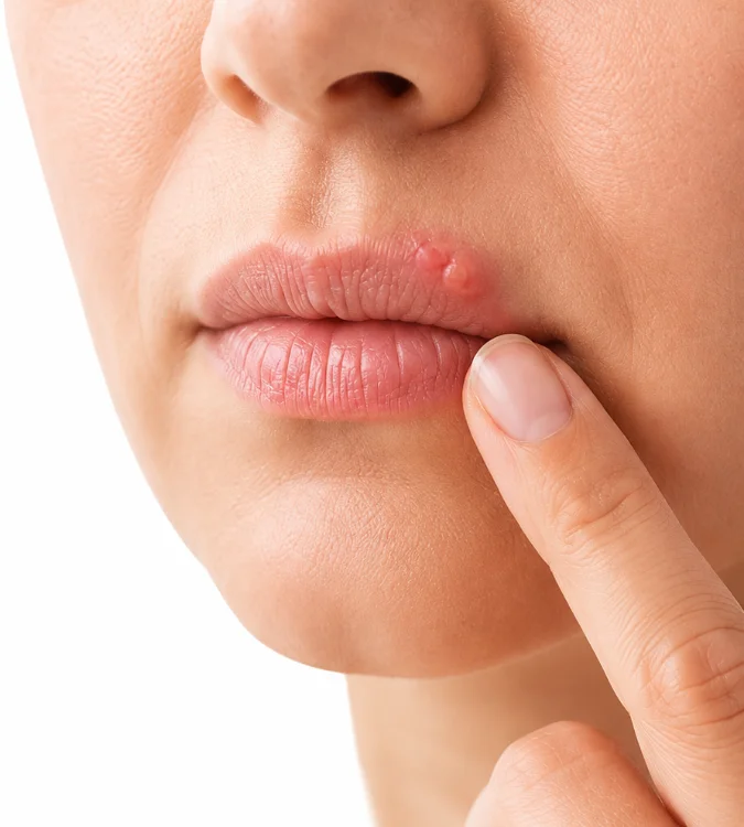 Close-up of a person touching a cold sore on their lip