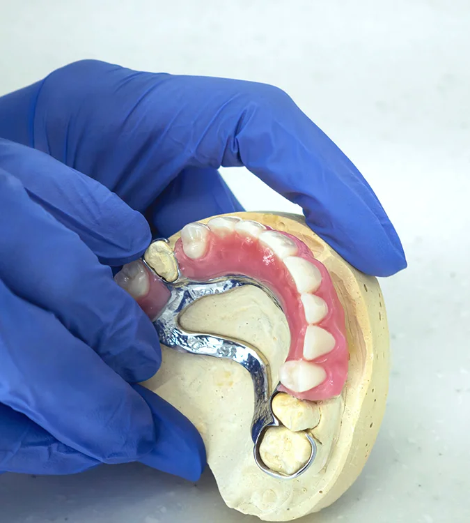 Gloved hand holding a partial denture on a dental model