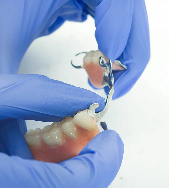 Gloved hands holding a cobalt chrome partial denture
